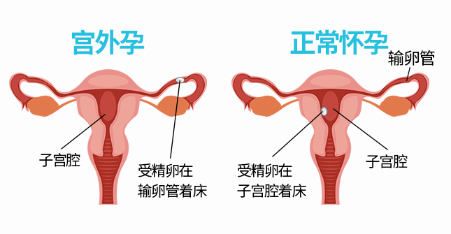 输卵管炎症会导致宫外孕吗